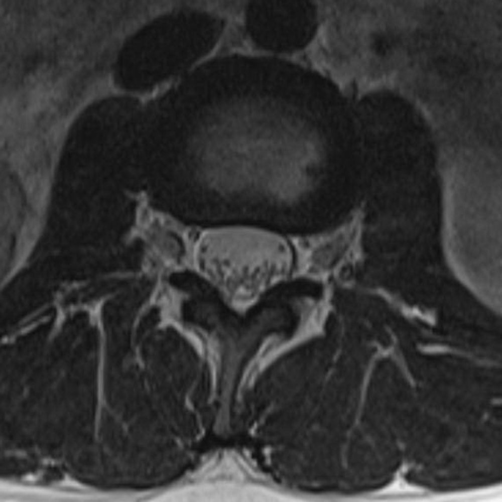 Axial T2 image through the lumbar spine, annotated in the next image. Note that the epidural space is most prominent surrounding the exiting nerves and along the dorsal thecal sac. As the ligamentum flavum thickens it can narrow the epidural space.
